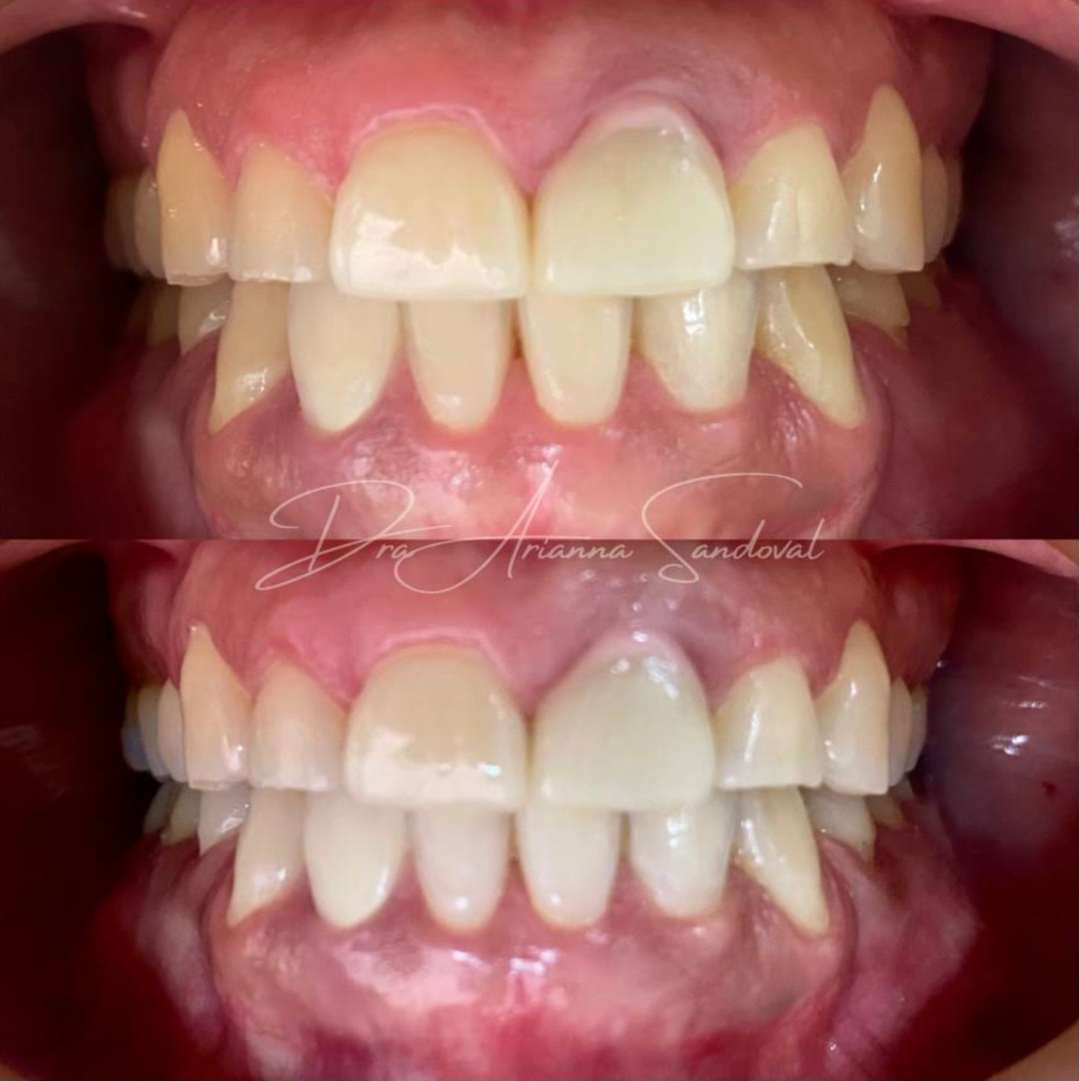 Caso de ortodoncia exitoso con brackets en Gud Dental Clinic mostrando progreso del tratamiento