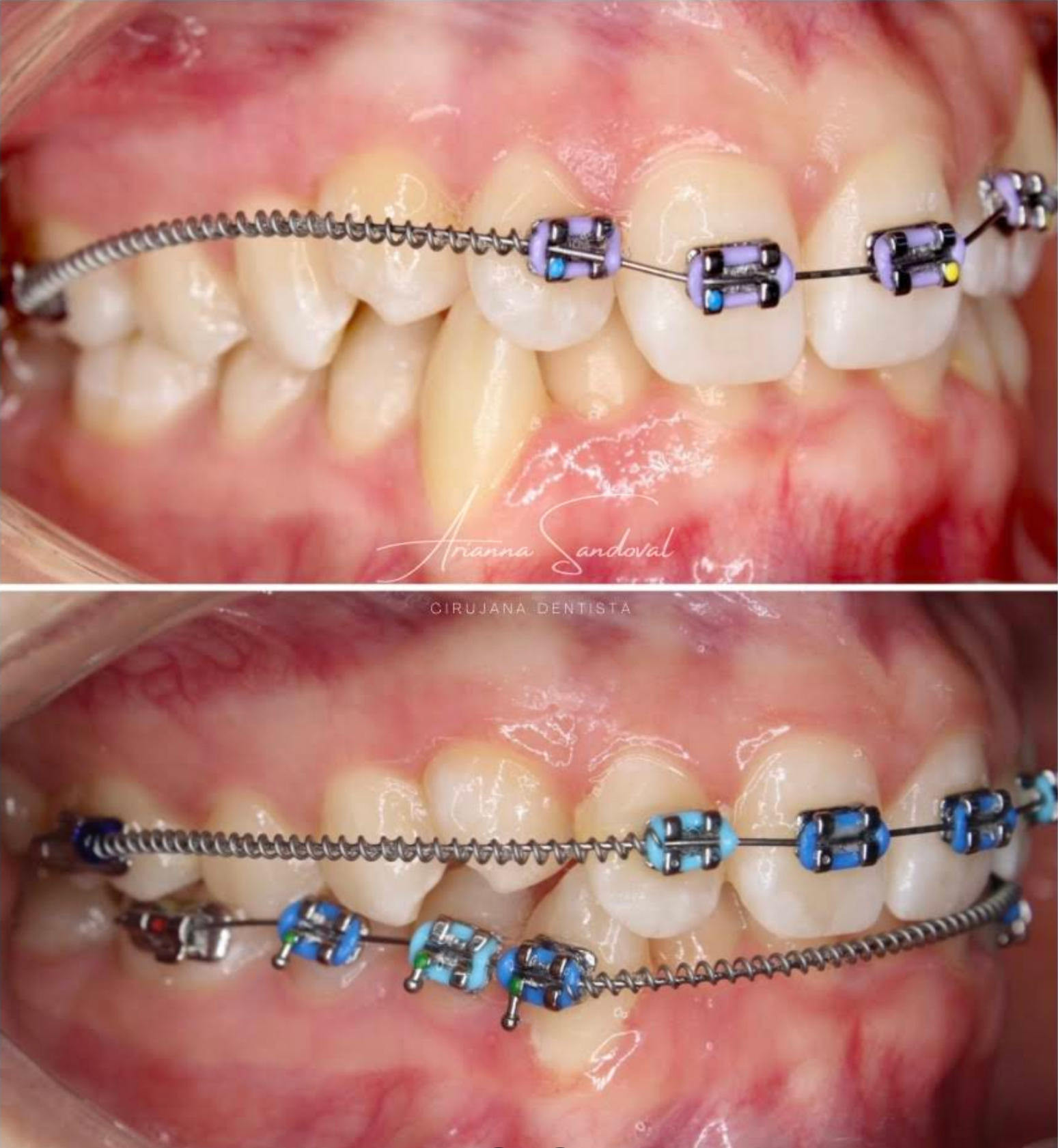 Resultado de tratamiento de ortodoncia con alineacion dental mejorada en Gud Dental Clinic