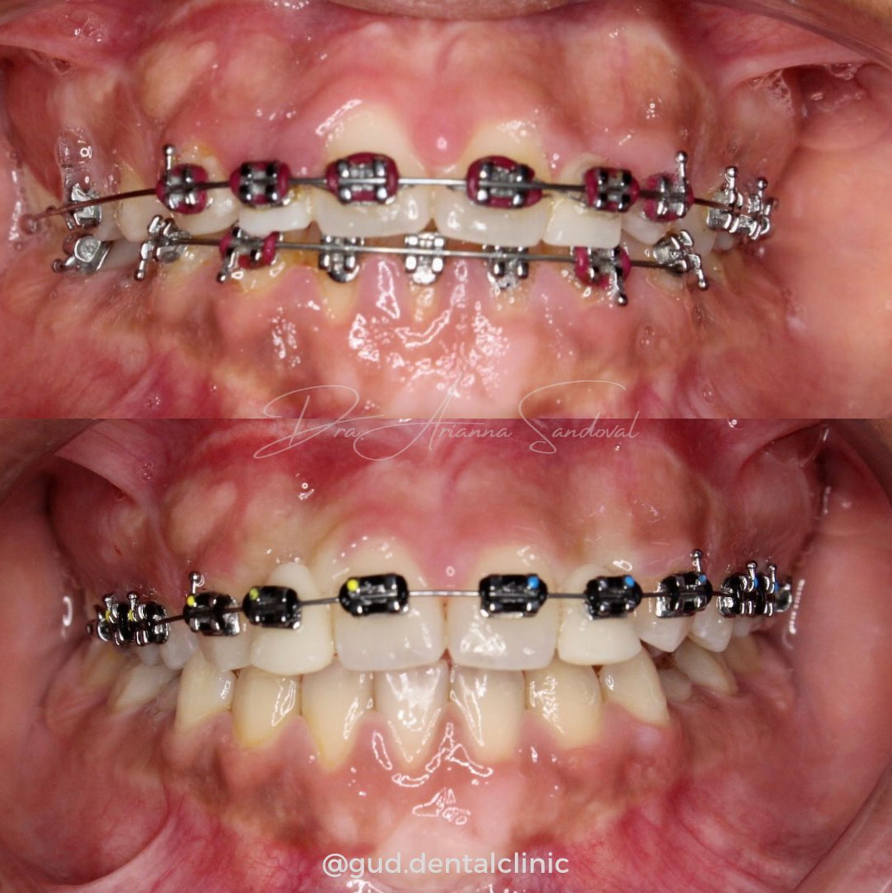 Transformacion dental con ortodoncia especializada por la Dra. Arianna Sandoval